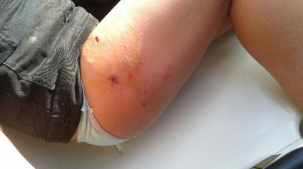 Illustration : Un chien ayant mordu une fillette de 8 ans récidive sur une mère de famille 